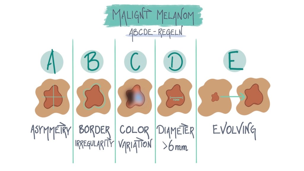 Malignt melanom - Hudförändringar - ABCDE-regeln - MSD Sverige